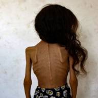 Why is the West now pretending to condemn famine?